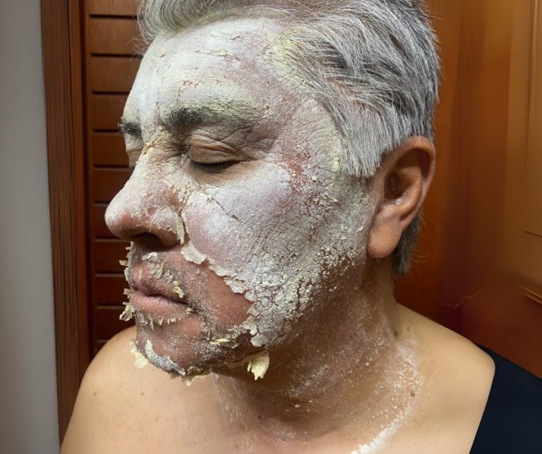 Curso de Peeling Acido Mandelico
